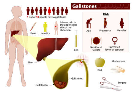 gallstones or cholelith. Medical Infographic set elements and symbols for design.のイラスト素材