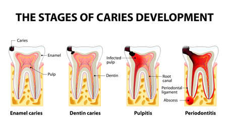 stages of caries development. Dental disease: caries, pulpitis and periodontitis stages of caries development. Dental disease: caries, pulpitis and periodontitis
