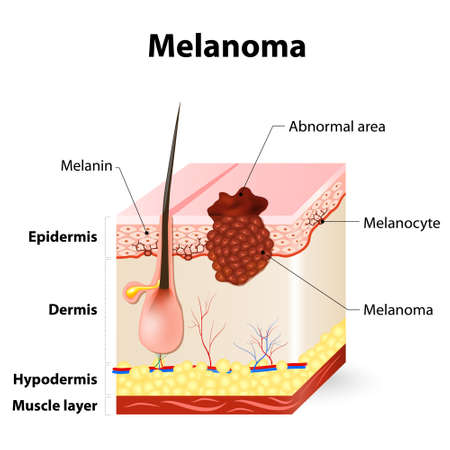 Melanoma or skin cancer. This rare type of skin cancer originates from melanocytes. layers of the human skin.のイラスト素材