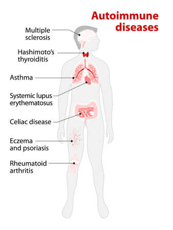 Tissues of the human body affected by autoimmune attack. Disease and organs on silhouette manのイラスト素材