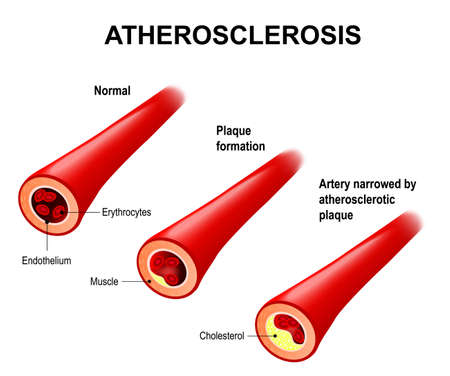 Atherosclerosis. Arteries are narrowed when fatty deposits called plaques build up inside. Atherosclerosis reduce the blood supply to vital organs such as the heart, brain and intestines.のイラスト素材