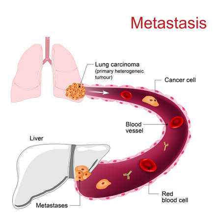 Primary lung cancers metastasize to the liver. Metastasis or Metastasesのイラスト素材