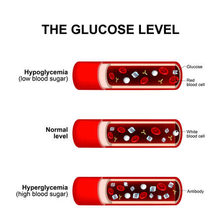 blood sugar level or glucose level. Normal level, Hyperglycemia and Hypoglycemia. blood vessels with crystals of sugar (glucose ), white and red blood cellsのイラスト素材