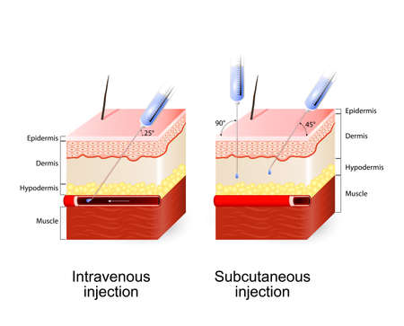 Intravenous therapy and Subcutaneous injection. Angle and depth of injections