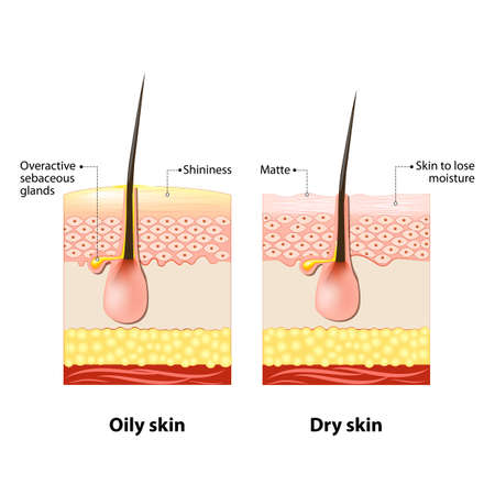 Oily & dry skin. Different. Human Skin types and conditions. A diagrammatic sectional view of the skin.のイラスト素材