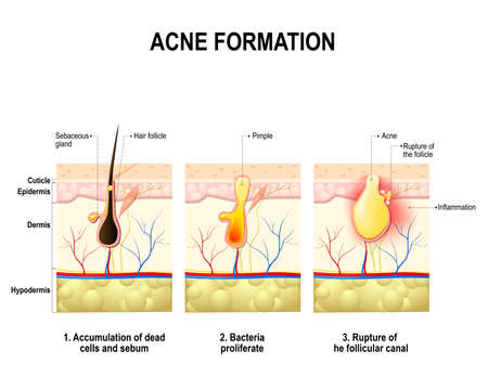 Three stages of the acne formation in the human skin. The sebum in the clogged pore promotes the growth of a bacteria Propionibacterium Acnes. This leads to the redness and inflammation, that associated with pimples. For clinics and Schoolsのイラスト素材