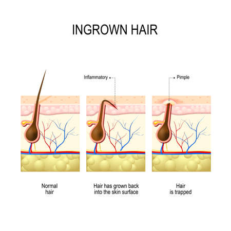 Ingrown Hair After Hair Removal And Shaving Buried Hair