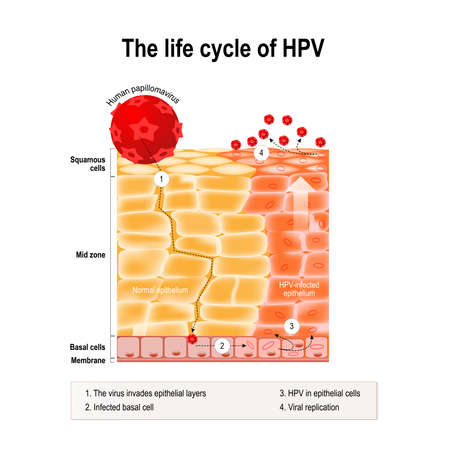 life cycle of hpv in the human epithelium. hpv - Human papillomavirus infection which causes warts and cervical cancer (carcinoma of Cervix) - Malignant neoplasm arising from infected epithelial cellsのイラスト素材