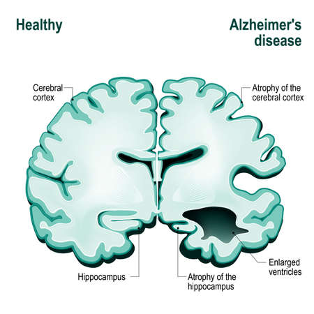 Cross section of the human brain. Healthy brain compared to Alzheimer's disease (dementia, senility)のイラスト素材