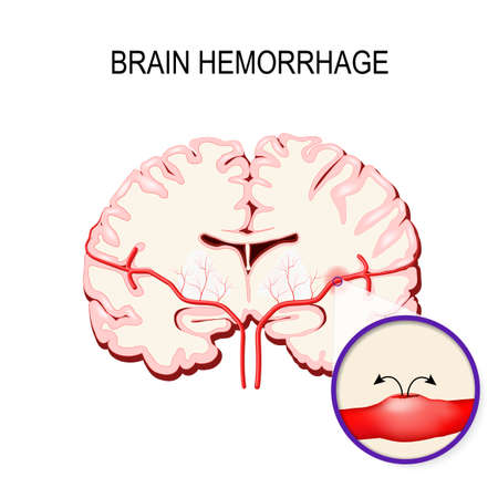 Cerebral hemorrhage. Stroke and Bleeding inside the human brain.のイラスト素材