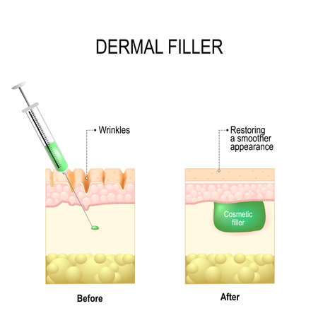 injectable cosmetic filler or Dermal fillersのイラスト素材