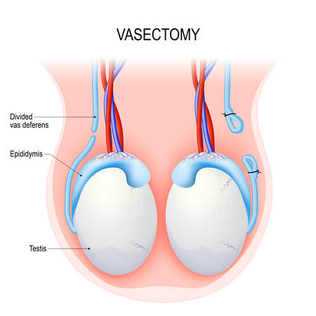 Vasectomy. Surgical procedure for male sterilization. Open-ended method and ligating (suturing). Male reproductive anatomy after vasectomy. Testicles. Vector diagramのイラスト素材