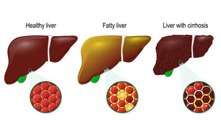 Liver disease. Healthy, fatty and cirrhosis of the liver. liver cells (hepatocyte). のイラスト素材