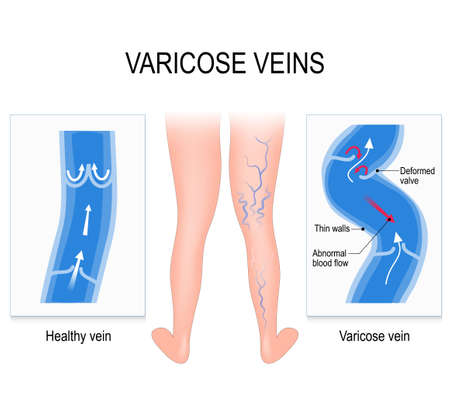 Varicose veins and Normal vein. Medical illustrationのイラスト素材