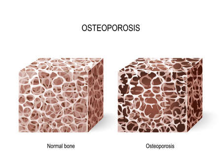 Osteoporosis.のイラスト素材