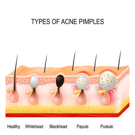 Types of acne pimples. Healthy skin, Whiteheads and Blackheads, Papules and Pustulesのイラスト素材