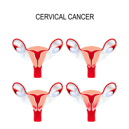 Cervical cancer staging.  Carcinoma of Cervix. Malignant neoplasm arising from cells in the cervix uteri.のイラスト素材