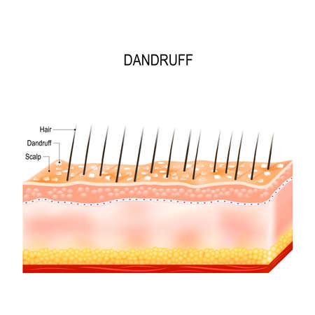 Dandruff. seborrheic dermatitis can occur due to dry skin, bacteria and fungus on the scalp. It causes formation of dry skin flakes on the scalp. Layers of the human skinのイラスト素材