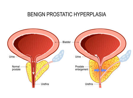 Benign prostatic hyperplasia (BPH). prostate enlargement. Diagram of a normal prostate and Prostatitisのイラスト素材