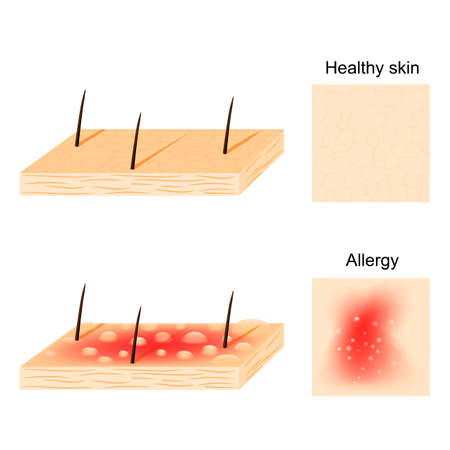 Allergy healthy skin and allergic reactions top and side view.のイラスト素材