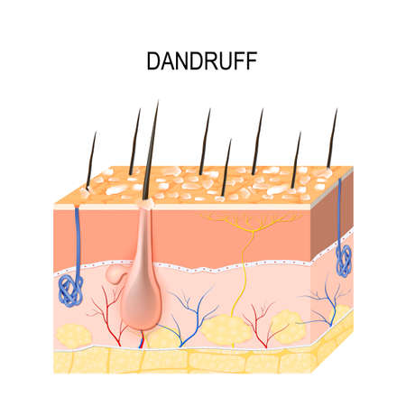 Dandruff. seborrheic dermatitis can occur due to dry skin, bacteria and fungus on the scalp. It causes formation of dry skin flakes on the scalp. Layers of the human skinのイラスト素材
