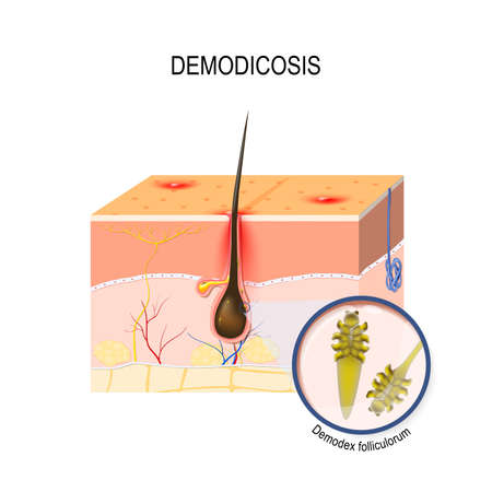 Vector of demodicosis. face mites. - ID:1-90056147 - Royalty Free Image ...