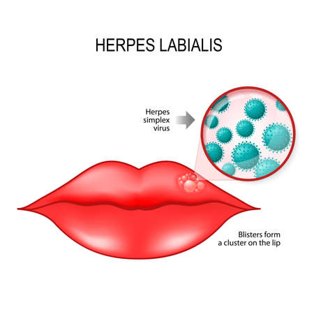 Herpes labialis (blisters) on the lip. cause is herpes simplex virus (under a magnifying glass). Vector diagram for medical useのイラスト素材