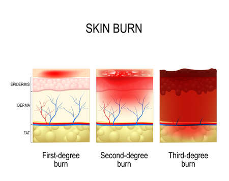 skin burn. Three degrees of burns. type of injury to skin. step of burnのイラスト素材