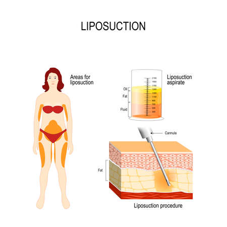 Liposuction process and areas for liposuction, cosmetic surgery for remove fat from the human body illustration.のイラスト素材