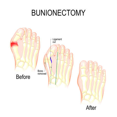 Bunionectomy is a procedure to correct of pathologies and deformity of the joint connecting the big toe to the foot.のイラスト素材