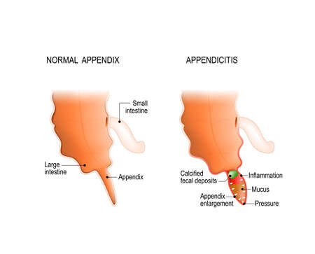 Appendicitis. Healthy and Inflamed appendix.のイラスト素材