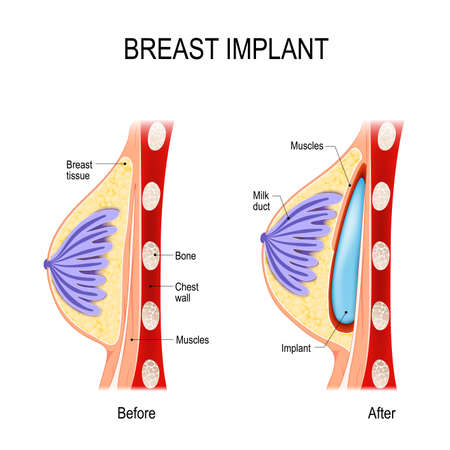 Breast Implant. Cosmetic (plastic) surgery. method of the Submuscular Pocket (under the muscle). This method is used in women who have minimal breast tissueのイラスト素材