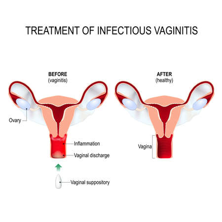 Treatment of infectious vaginitis. Cross-section of the uterus with vaginal infection, and healthy womb. inflammation of the vagina. Women's Health. Human anatomy. Vector diagram for medical use.のイラスト素材