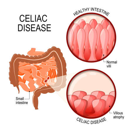 Celiac disease. Small intestinal with normal villi, and villous atrophy. Diagram showing changes in intestinal. Celiac disease manifested by blunting of villi.