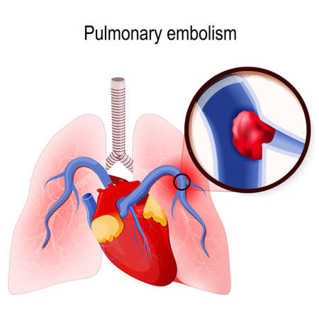 Pulmonary embolism. Blockage of the main artery of the lung or one of its branches by a blood clot that has traveled from elsewhere in the body through the bloodstream. Human lungs and heart.のイラスト素材