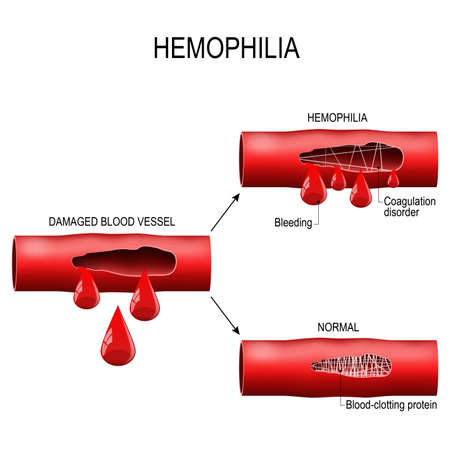 Hemophilia. damaged blood vessel, Haemophilia (Coagulation disorder) and healthy blood vessel after bleeding.のイラスト素材