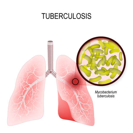 Tuberculosis is an infection caused by bacteria. Lungs of infected person. Mycobacterium...