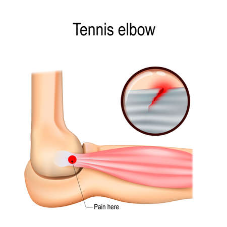 Tennis elbow or lateral epicondylitis. Vector illustration for medical useのイラスト素材
