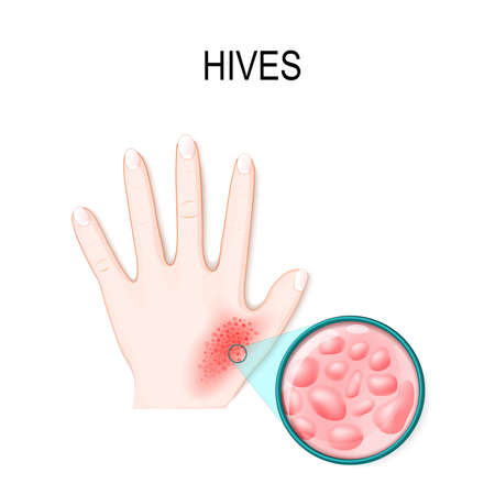 skin rash. Hives or urticaria. hand of the patient and magnification skin with red itchy bumps. Skincareのイラスト素材