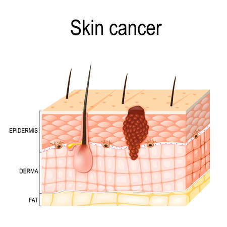A skin cancer originates from melanocytes.のイラスト素材