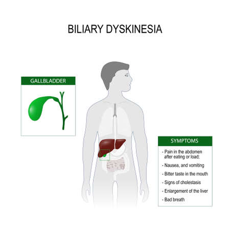 Biliary dyskinesia is a disorder of biliary part of the digestive system in which bile can not move normally. Symptoms disease and close-up of gallbladder. humans silhouette with highlight liver. Vector illustration for medical useのイラスト素材