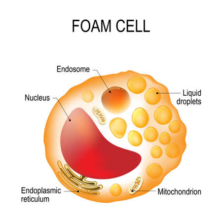 Structure of the foam cell. Foam cell is a swollen macrophage filled with lipid inclusions. This cell serve as the hallmark of early stage atherosclerotic lesion formation. Cholesterol-loaded cells (foam cells) make plaque unstable, leading to heart attacks and strokes.のイラスト素材
