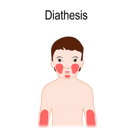 Diathesis. Atopic dermatitis (atopic eczema). Location on a human skin. A child with red areas of diathesis location.のイラスト素材