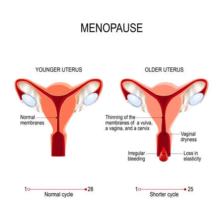 Younger and older women uterus. Menopause or climacteric. Vector diagram for medical useのイラスト素材