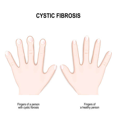 Finger clubbing in cystic fibrosis (genetic disorder). difference between healthy hand and Fingers of a person with cystic fibrosis. Nail clubbing Symptoms (Drumstick fingers or watch-glass nails)のイラスト素材