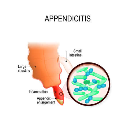Appendicitis. Human appendix and bacterial growth inside the appendix causing inflammation. Vector illustration for medical useのイラスト素材