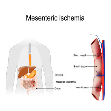 Mesenteric ischemia is an injury to the small intestine occurs due to not enough blood supply. Human silhouette with internal organs. Vector illustration for biology, scientific, and medical use.のイラスト素材