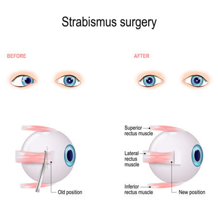Strabismus Surgery. Eye muscle recession. Extraocular Muscle Anatomy. surgeon alters the attachment site of the muscle, cutting the muscle from the surface of the eye and reattaching it further back on the eyeball, away from the front of the eye.のイラスト素材