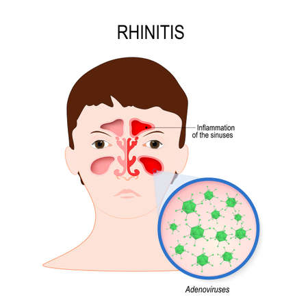 Viral sinusitis (Rhinitis) caused by adenovirus infection. Face with nasal cavity and close-up viral infection that caused this diseaseのイラスト素材