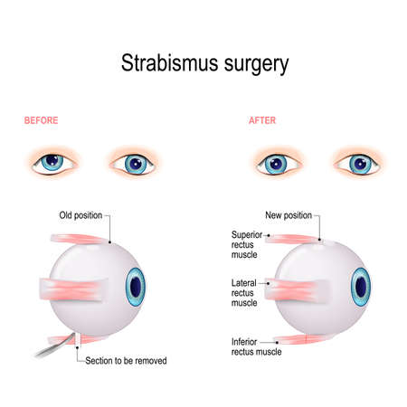 Strabismus Surgery. Hypertropia. Eye muscle recession. Extraocular Muscle Anatomy. surgeon alters the attachment site of the muscle, cutting the muscle from the surface of the eye and reattaching it further back on the eyeball, away from the front of the eye.のイラスト素材